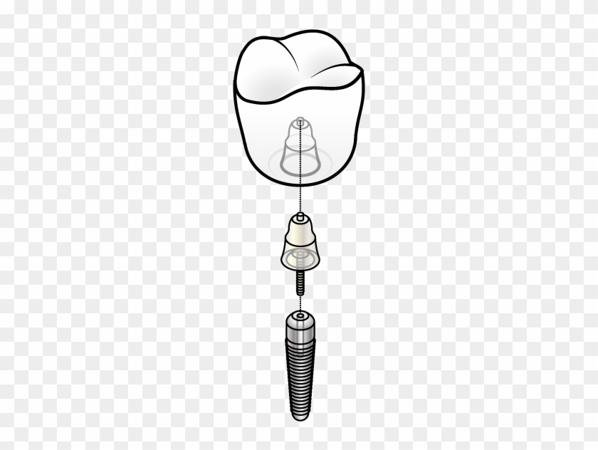 If Missing Teeth Are Leaving You Feeling Self-concious - Dental Implant #563470