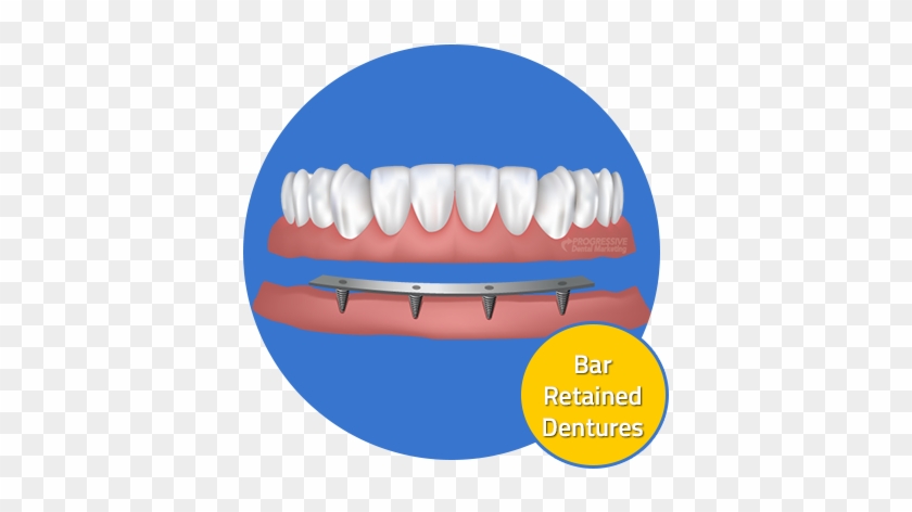 Custom Dental Offers A Variety Of Dental Implant Options - Dentures #563502