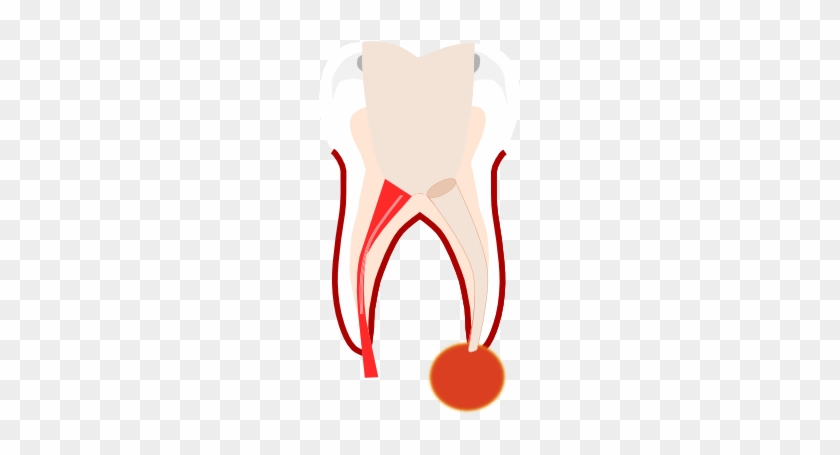 Preparation Of The Root Canals - Preparation Of The Root Canals #563503