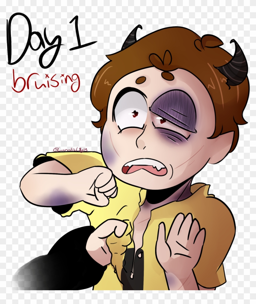 {day 1} Bruising By Lunaticlily13 - Drawing #571970