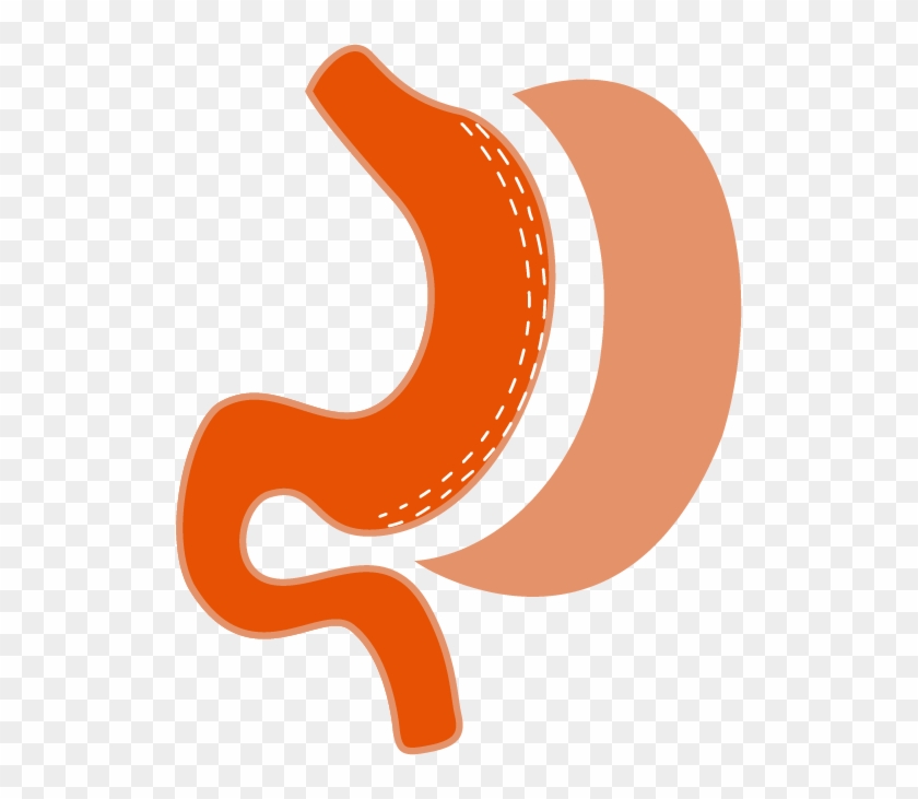 Laparoscopic Sleeve Gastrectomy - Graphic Design #580470