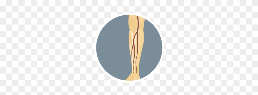 Peripheral Arterial Disease Illustration - Illustration #586506