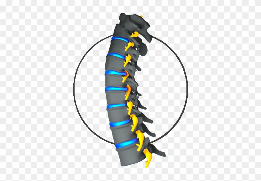 Cervical Myelopathy - Insect #594095