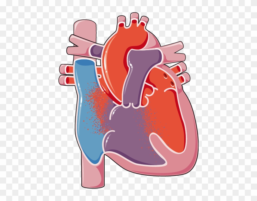 Congenital Heart Disease Atrioventricular Canal Defect - Ventricular Septal Defect #596500