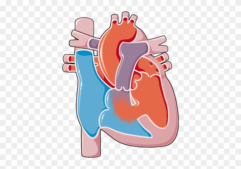 Congenital Heart Disease Ventricular Septal Defect - Heart Septal Defect #612488