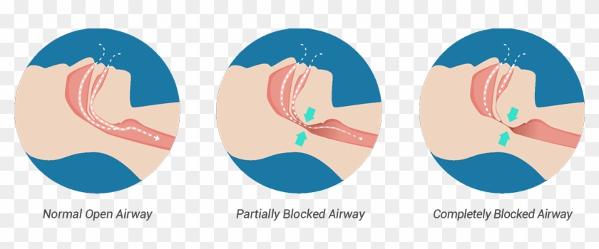 Hydrated Reduces Snoring - Causes People To Snore #620245