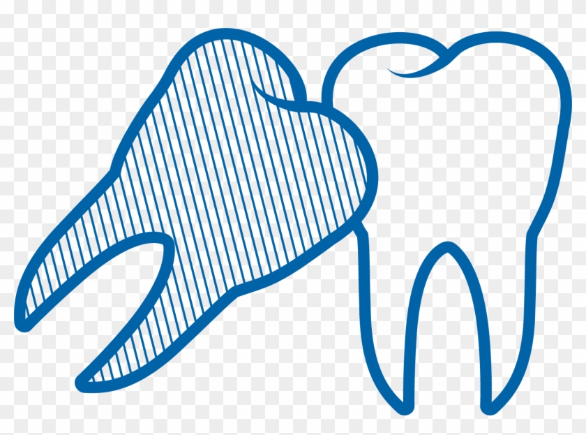 Wisdom Tooth Removal - Wisdom Tooth Removal #622518
