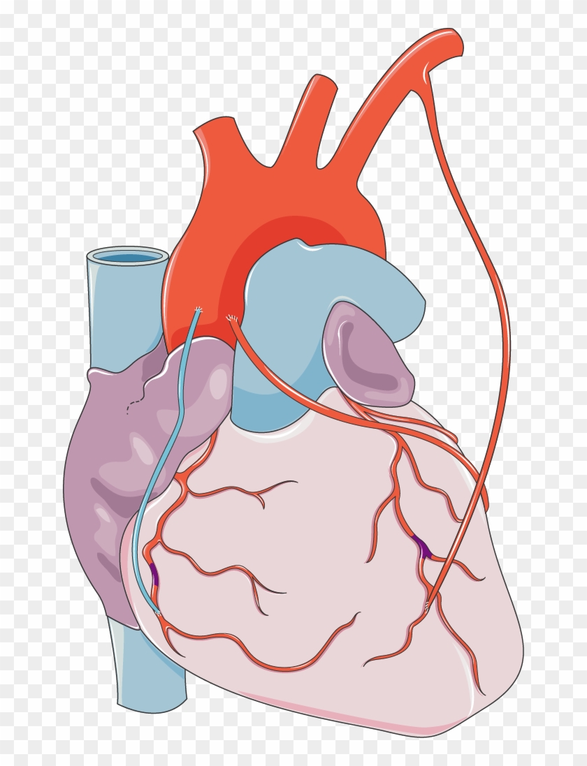 Download The Image - Macrophage In Myocardial Infarction #635911