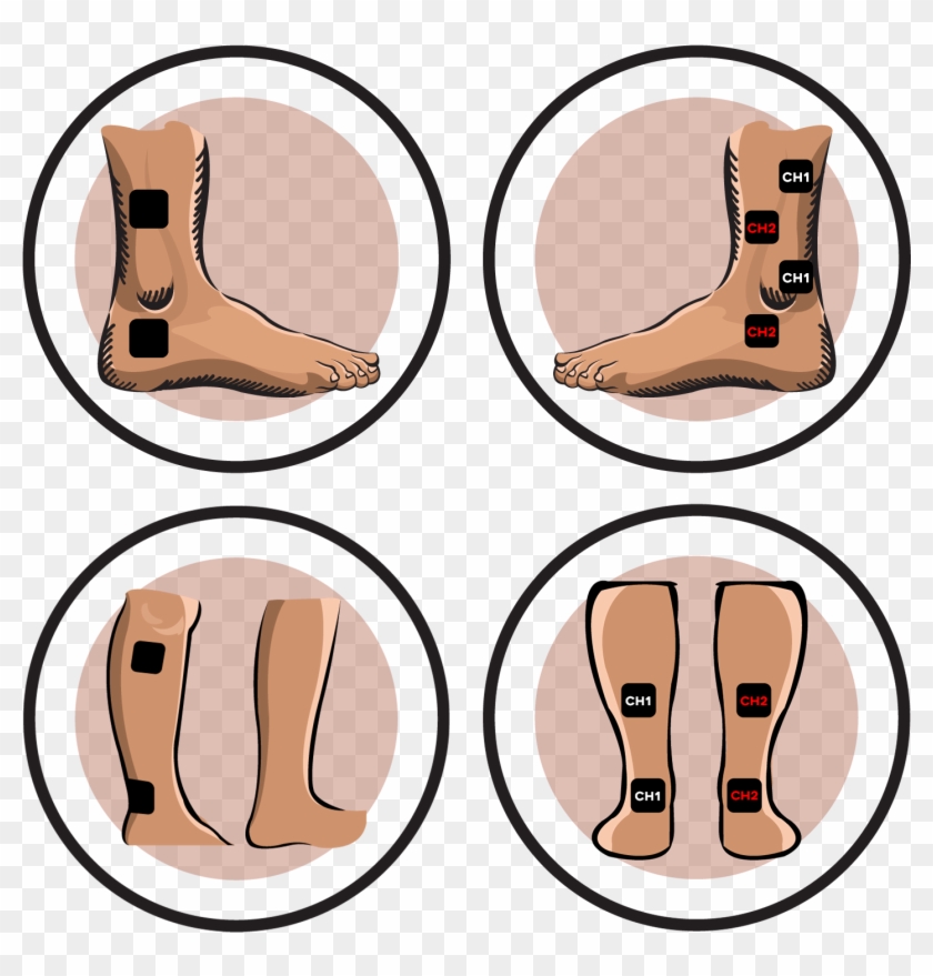 - Ireliev - Ankle Tens Unit Placement #641023