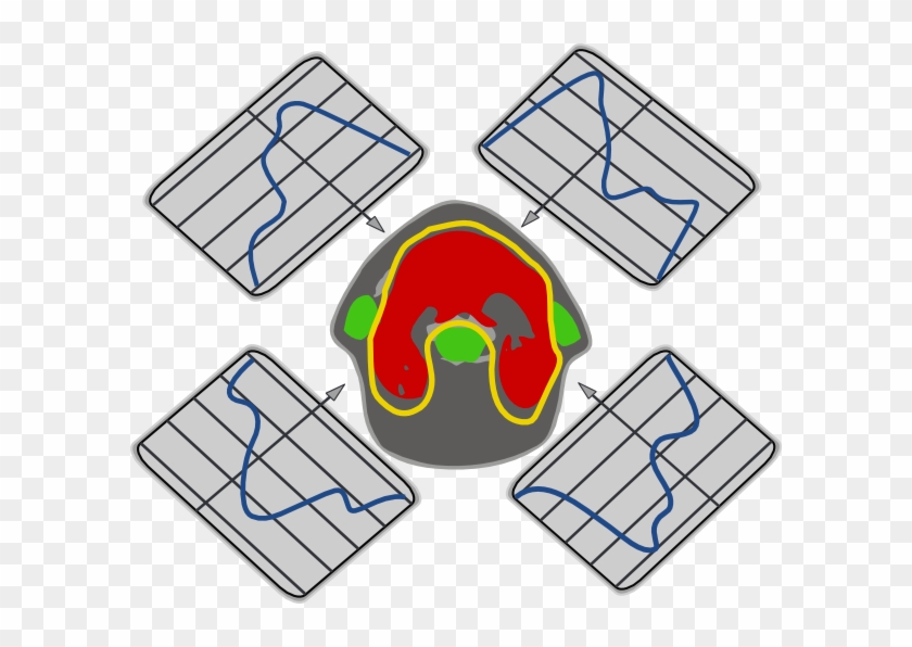 Mri 20clipart - Imrt #656215