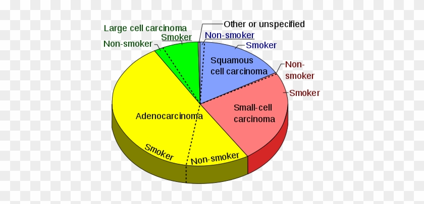 Pie Chart Showing Incidence Of Adenocarcinoma Of The - Most Common Lung Cancer #657317