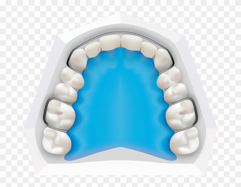 Removable Braces At Toothbeary Removable Retainers - Illustration #685953