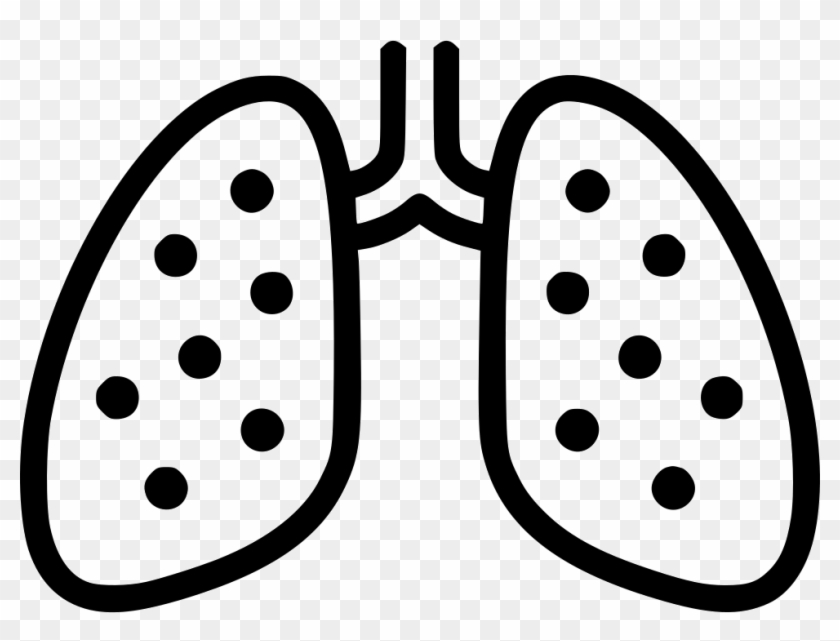 Lungs Chest X Ray Anatomy Tuberculosis Pneumonia Comments - Pneumonia #695817