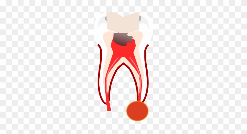 Without Endodontic Treatment The Only Other Alternative - Without Endodontic Treatment The Only Other Alternative #704955