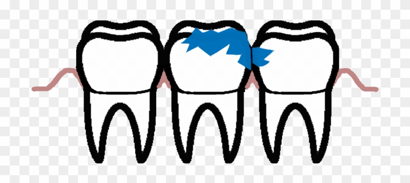 Dental Caries Is An Extremely Frequent Lesion Of The - Dental Caries Is An Extremely Frequent Lesion Of The #710564