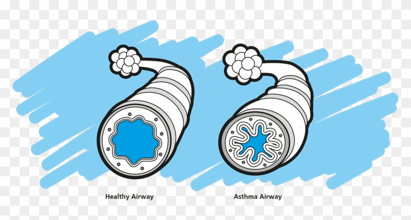 Normal & Asthma Airways - Asthma Airway Png #712388