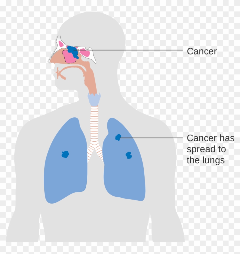 Open - Sinus In Lungs #733522