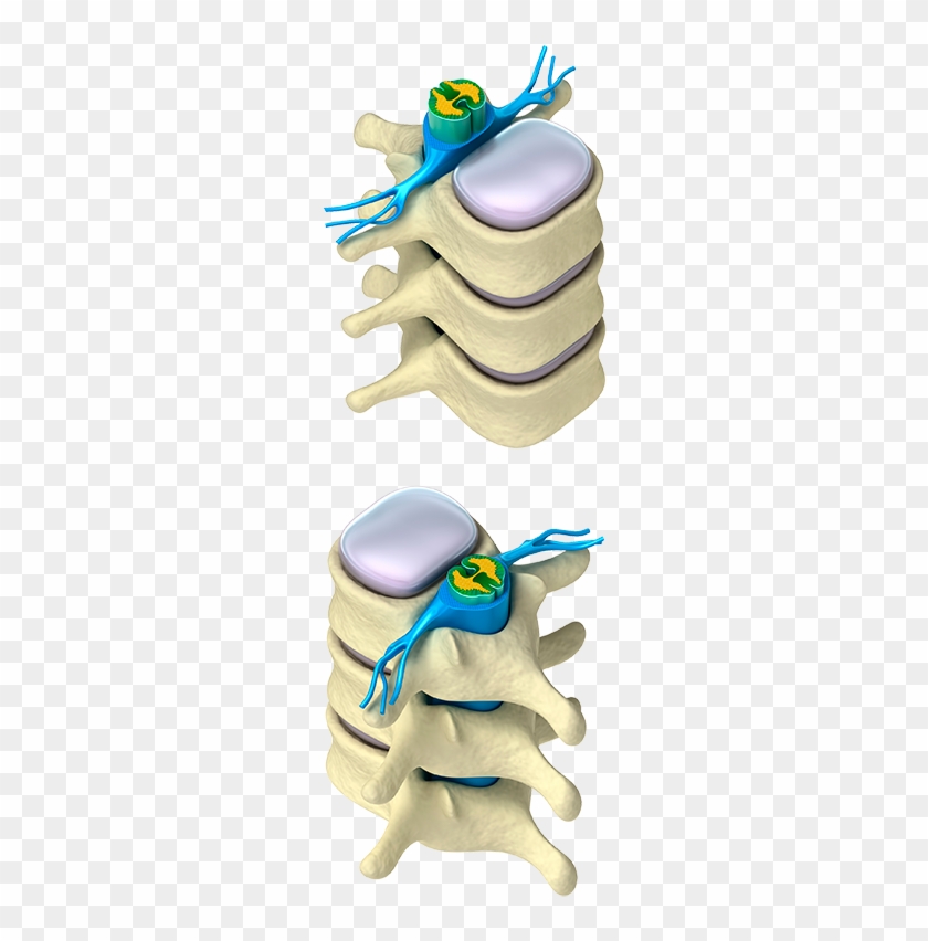 Finally A Gentle, Safe, And Effective Treatment Protocol - Intervertebral Canal #733757