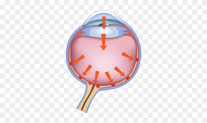 A Sustained Fluid Pressure On The Optic Nerve Of The - Glaucoma #739822