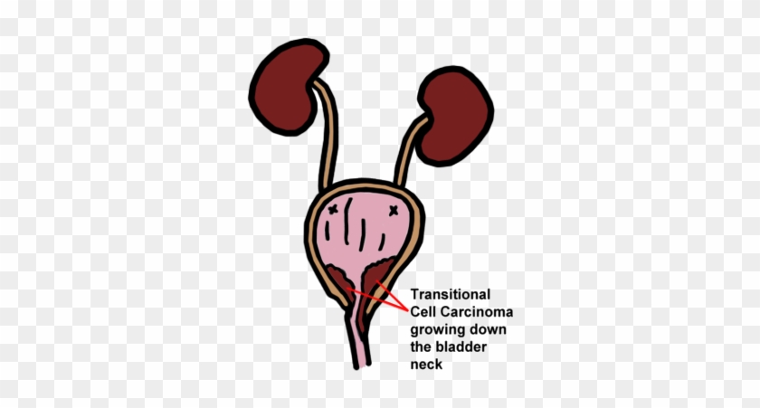 Urinary Tract With A Transitional Cell Carcinoma Growing - Transitional Cell Carcinoma Adalah #744218