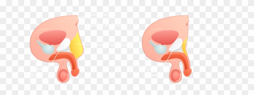 Circumcision - Male Pubic Fat Pad Removal #767059