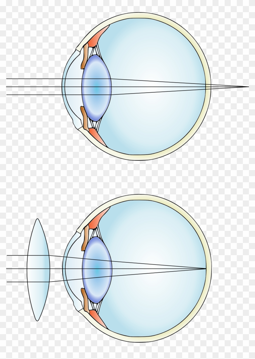 #physics117 Corrective Lenses Help The Eye Create An - Far-sightedness #767218