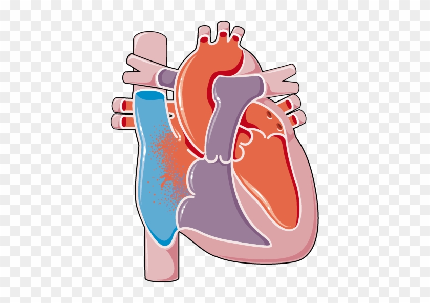 Congenital Heart Diseases Atrial Septal Defect - Ventricular Septal Defect #769706