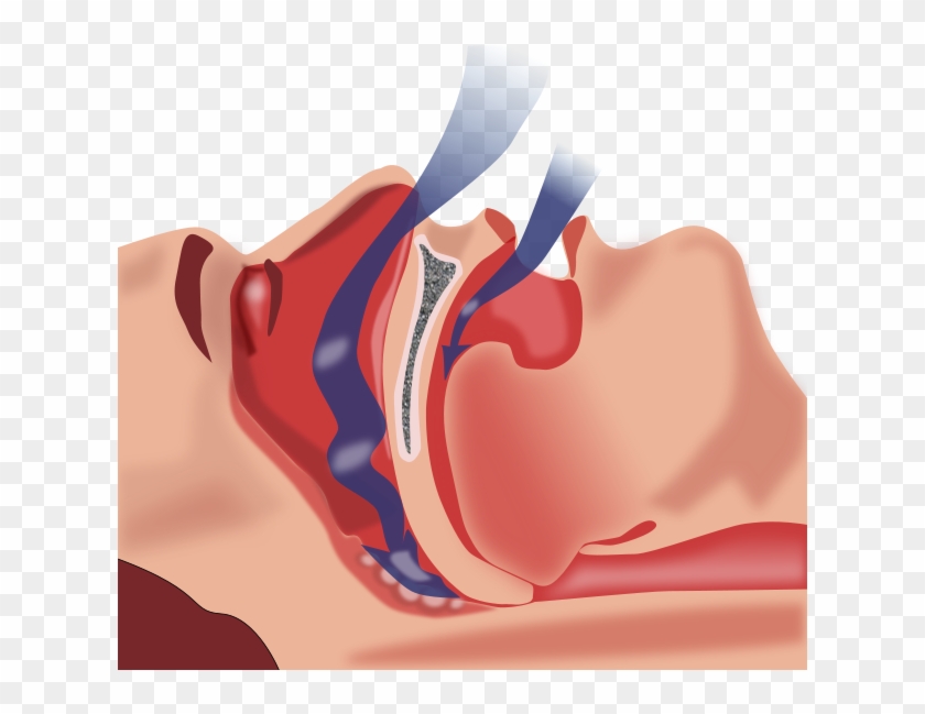 Illustration Of Obstruction Of Ventilation - Cpap Treatment For Obstructive Sleep Apnea #787946