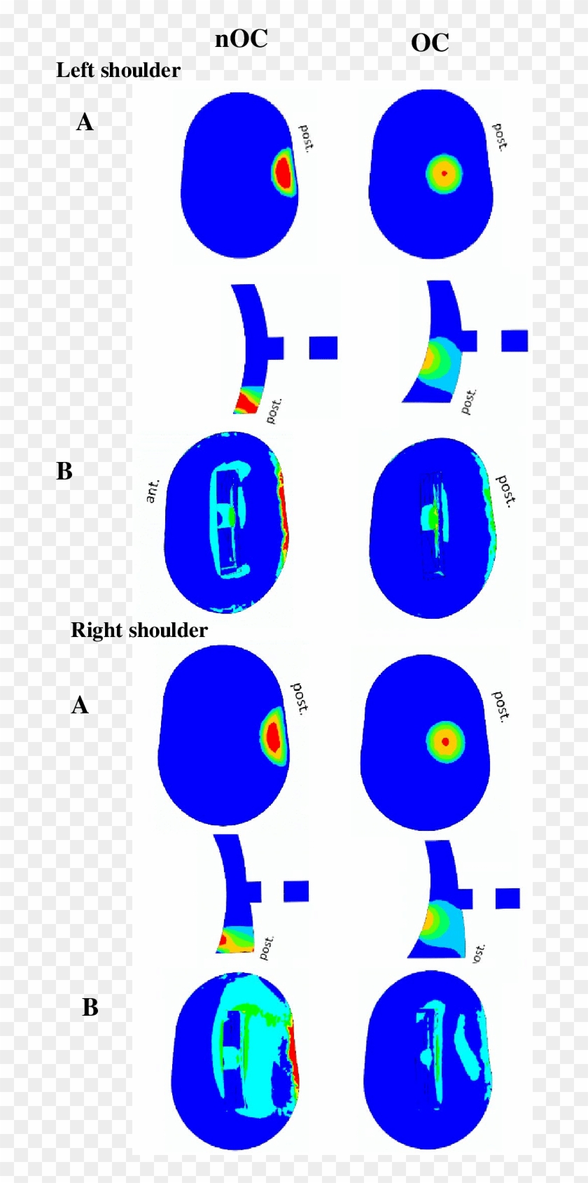 Maximum Principal Stress On Glenoid Implant For Left - Circle #843528