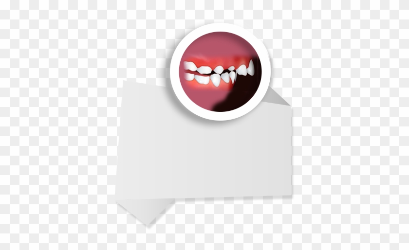 Upper Frontteeth - Protrusion - - Tongue #854623