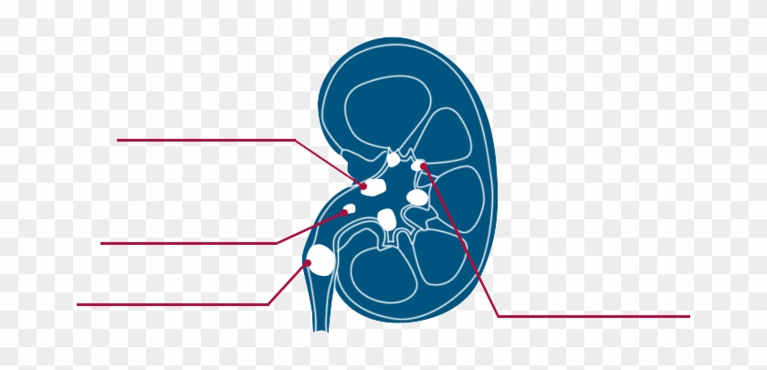 Types Of Kidney Stones - Types Of Kidney Stones #887951
