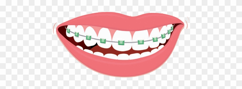 Color Me Braces - Dental Braces Clipart.