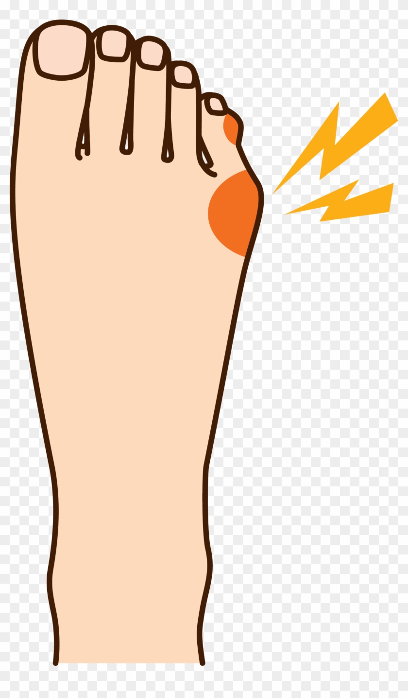 How To Relieve Your Tailor's Bunion Pain - How To Relieve Your Tailor's Bunion Pain #910592