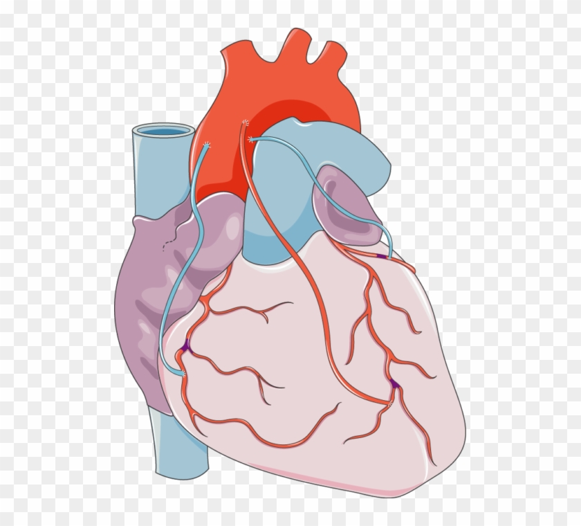 Coronary Artery Bypass Grafting - Bypass Surgery #919511