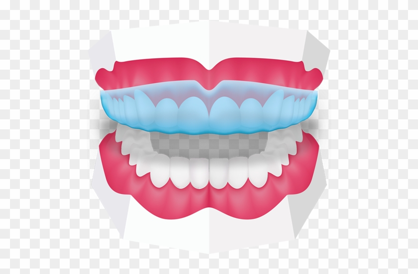 Mouthguards At Toothbeary - Orthodontics #930143