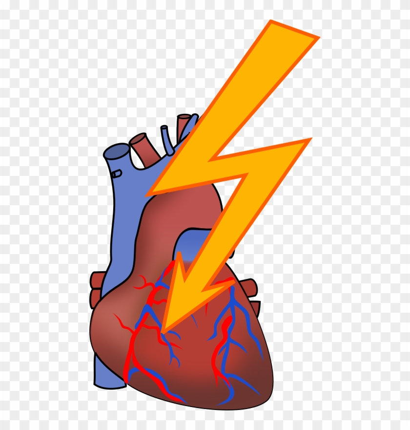 Clipart - Heart Attack - Heart Attack Clip Art - Full Size PNG Clipart