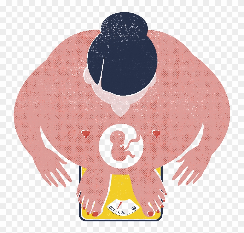 Pregnancy After Obesity Surgery Requires More Follow-up - Obesity In Pregnancy Cliparts #956337
