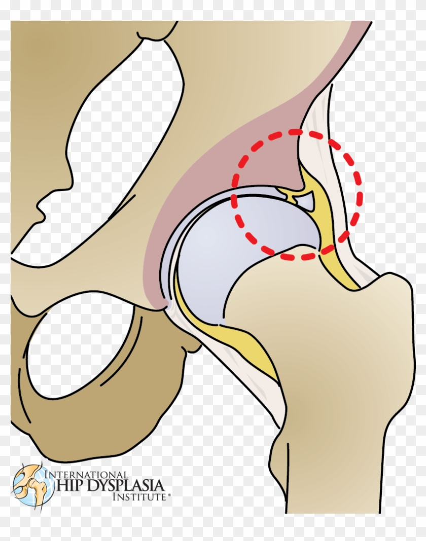 Torn Labrum Illustration [ ] Enlarge - Hip Dysplasia Labral Tear #971771