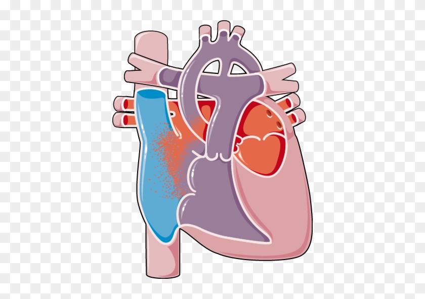 Congenital Heart Disease Hypoplastic Left Heart Syndrom - Birth Defect #1002242