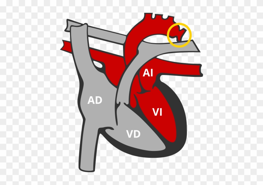 Coartación De Aorta - Verband Deutscher Industrie Designer #1022763