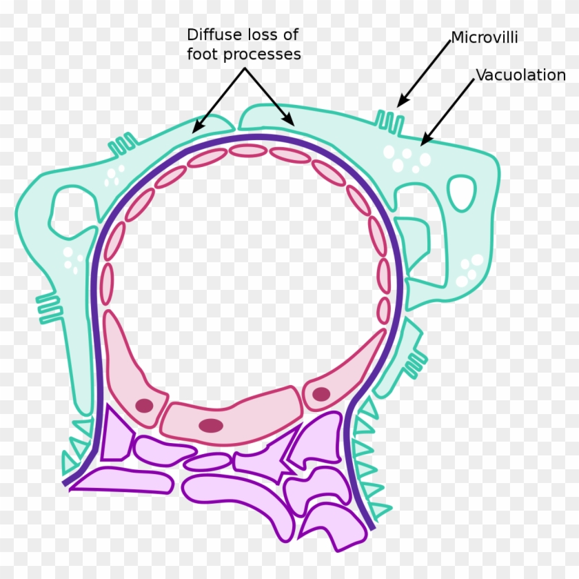 Minimal Change Nephrotic Syndrome #1056424