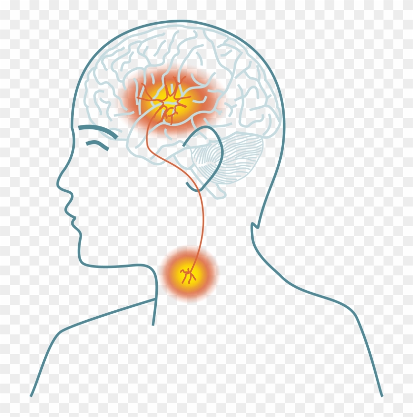 A Disease Of The People - Dysphagia Stroke #1061353