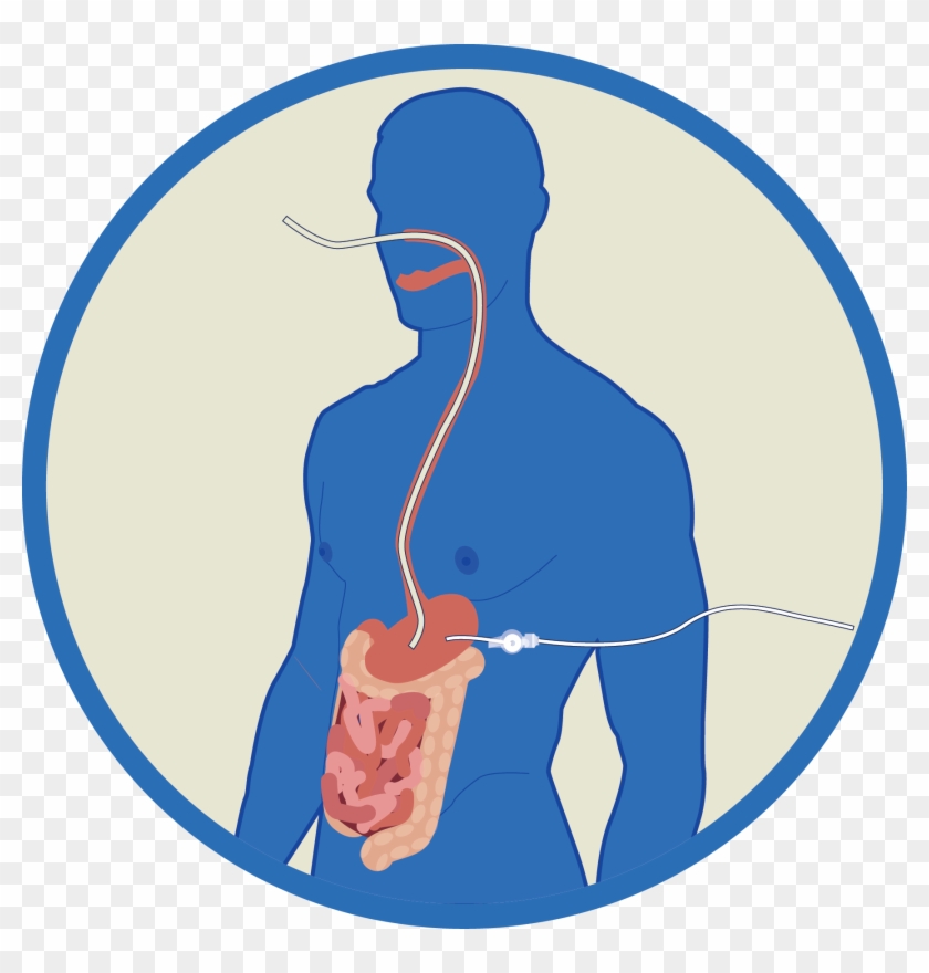 Enteral Tube Feeding Nasogastric , Nasojejunal (nj), - Danske Baptisters Spejderkorps #1072369