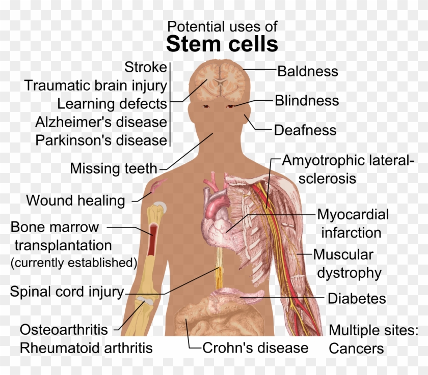 Treating Brain Injuries Stem Cell Transplants Promising - Uses Of Stem Cells #1078918