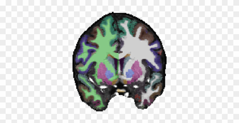 Brain With Schizophrenia Png #1079092