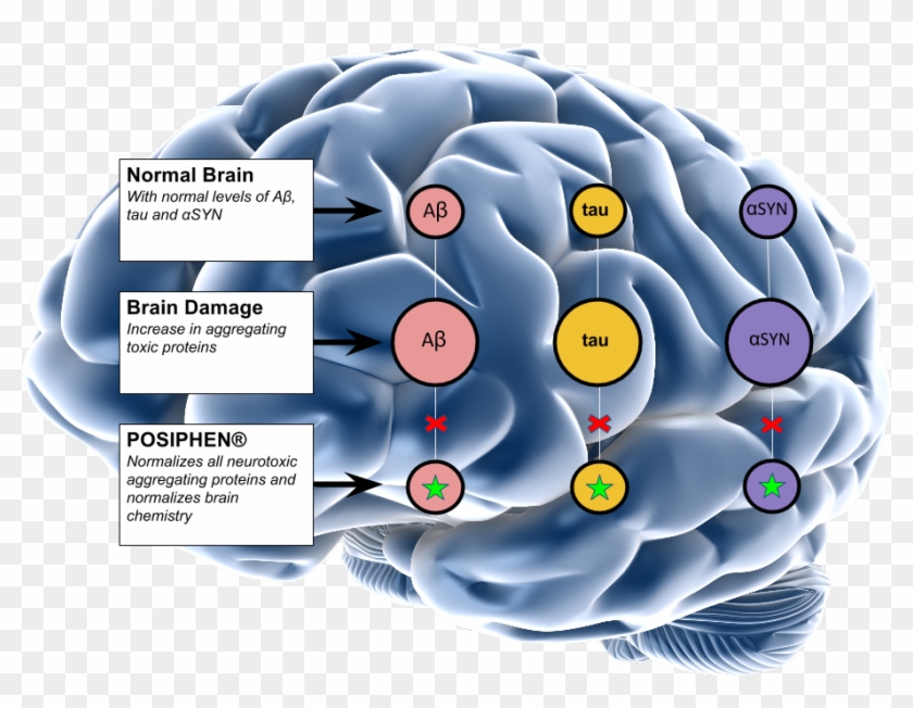 Our Pipeline - Alzheimer Ppt #1079109