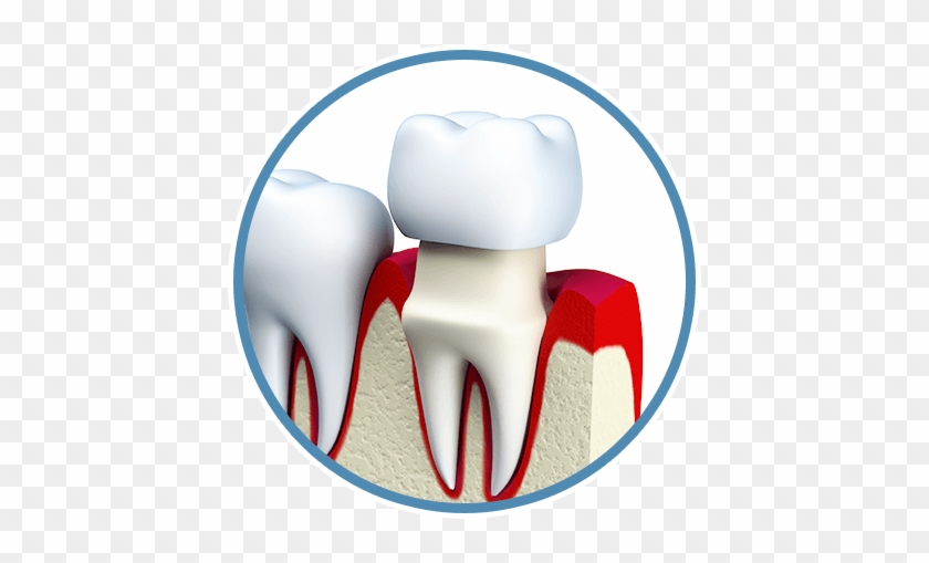 Dental Crowns - Dental Crown Png #1084863