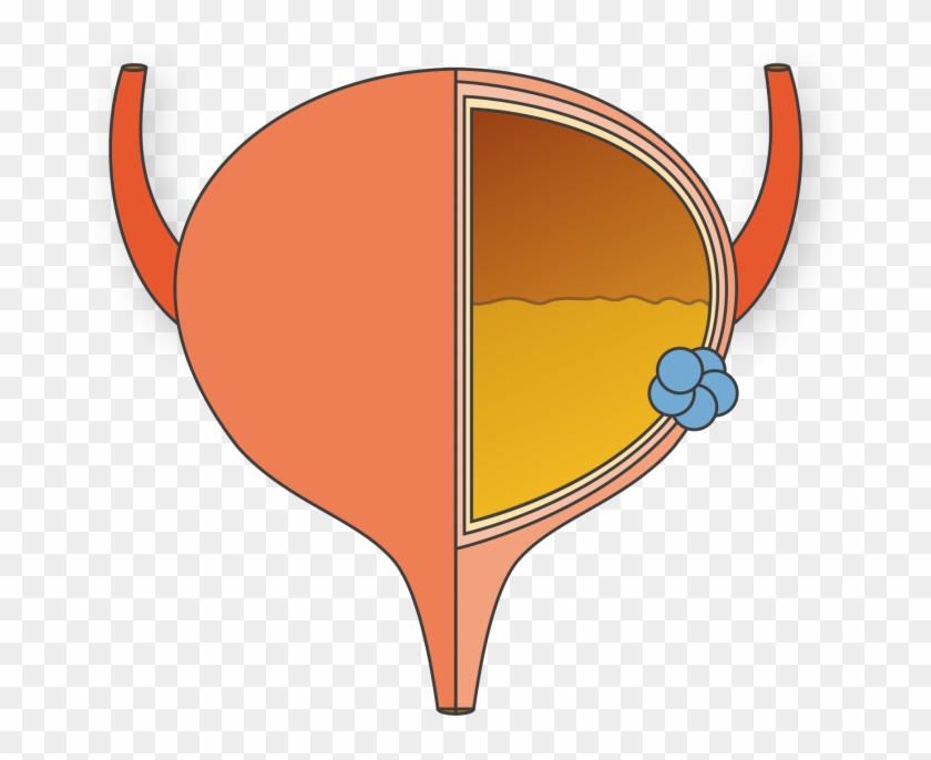 About Bladder Cancer - Vejiga Png #187756