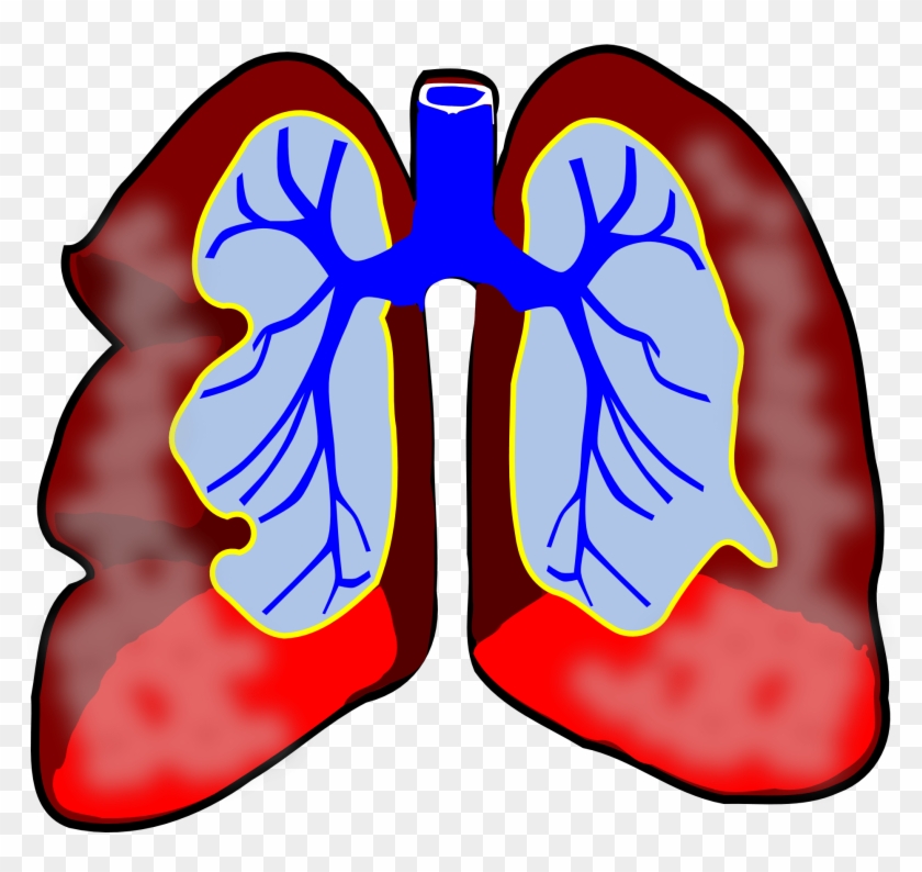 Respiratory Science, Diagram, Human, Air, System, Respiratory - Lung Cancer Clipart #188265