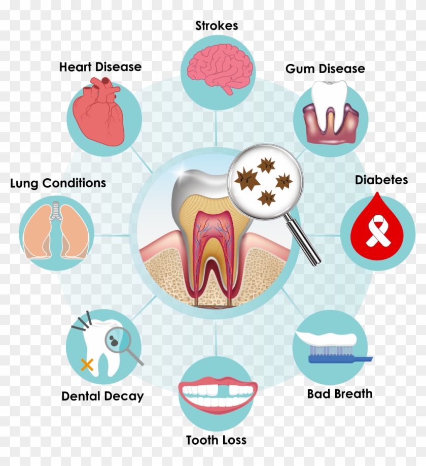 Decay Clipart Oral Health - Microbiota Oral #1124198